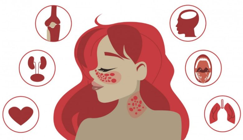 6 Fakta Penyakit Lupus: Penyebab, Gejala, Jenis, Hingga Cara Mengobatinya