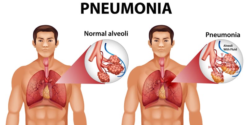Penyakit Pneumonia